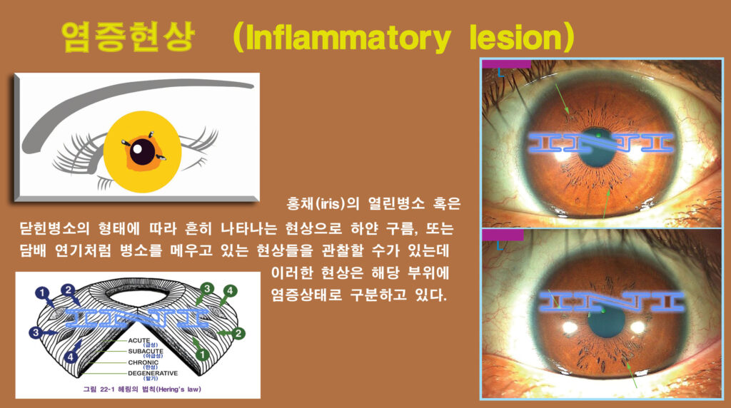 d874 좌 0염증현상 복사