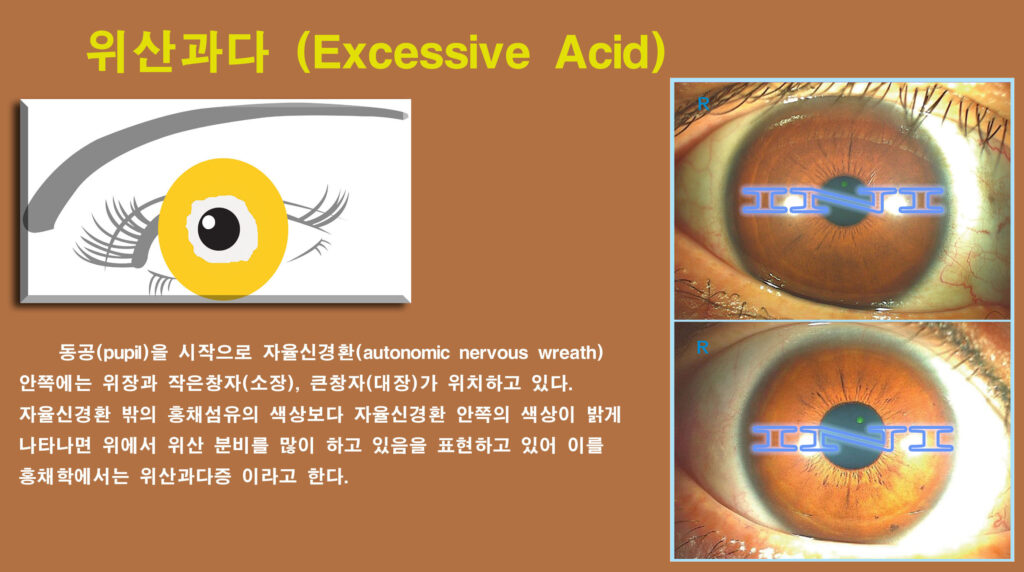 d874 좌 27 위산과다 복사