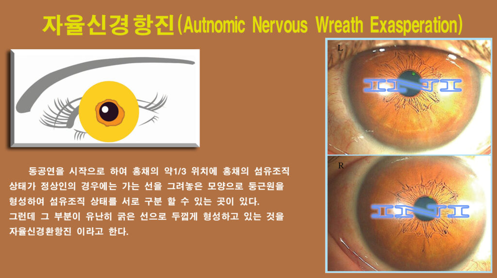 d874 좌 28 자율신경항진 복사