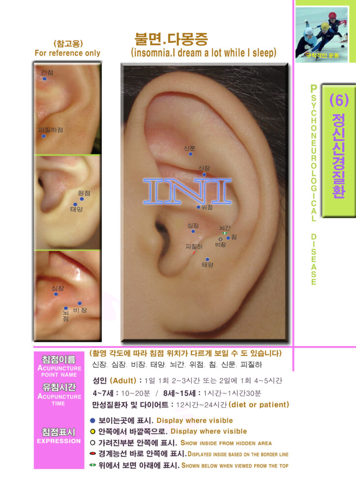 생활 이침요법 | Practical Auriculotherapy 이침3 1mk80 정신질환 불면 우 복사 사본