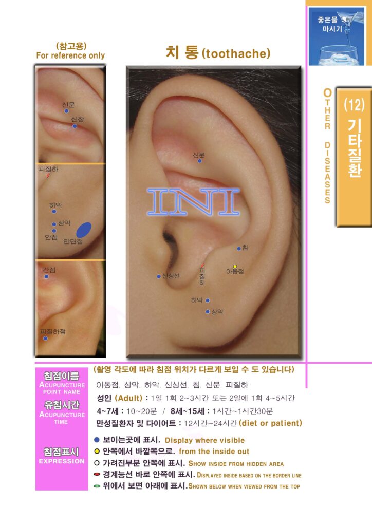 생활 이침요법 | Practical Auriculotherapy 이침5 1mk110 기타3 치통 우 복사